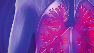 Lungenfibrose ist eine Lungenkrankheit, bei der das Gewebe der Lunge vernarbt.  Atembeschwerden sind die Folge. (Symbolbild) (Pixabay/kalhh)