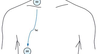 Anordnung der Elektroden zur Erfassung des IKG-Signals. (Bild: Analog Devices)