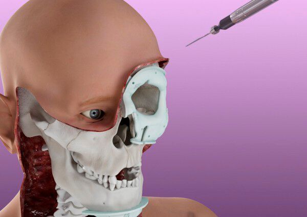 3D-Technologien von Materialise spielen eine entscheidende Rolle bei der weltweit ersten Ganzaugentransplantation. (Bild: 3DPC)