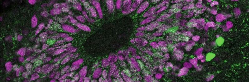 Ein Hirn-Organoid unter dem Mikroskop. Neuronale Stammzellen leuchten magentafarben. Die grüne Farbe zeigt Zellaktivität nach erhöhtem Kontakt mit dem Botenstoff Interleukin-6 an.