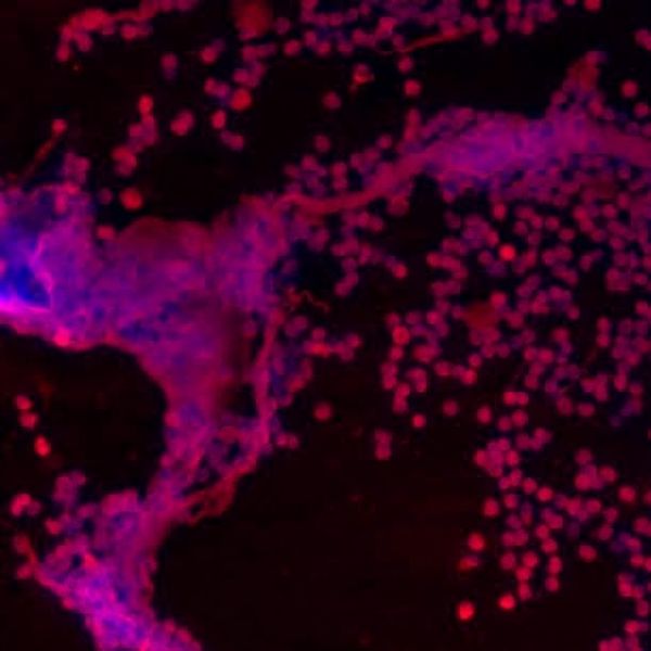 This image shows the white blood cells (neutrophils) in the spinal fluid during bacterial meningitis. The nuclear material DNA is marked blue and proteins in neutrophils are colored in red. The large aggregates as represented by overlapping areas of blue (DNA) and red (protein) portrays the extracellular DNA-protein networks called neutrophil extracellular traps (NETs).  (Tirthankar Mohanty)
