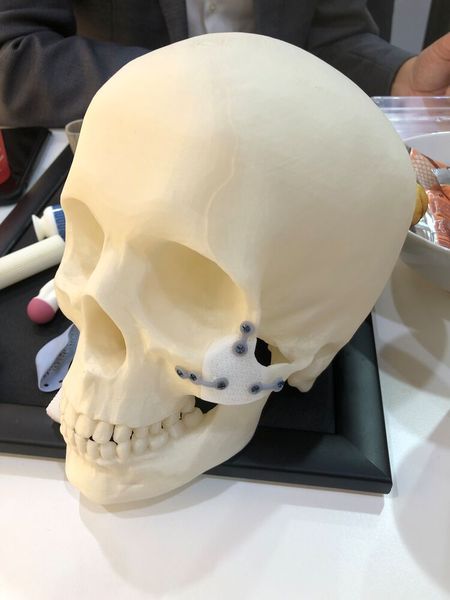 Ein Beispiel für bioresorbierbare Keramiken ist das Beispiel Jochbeinimplantat, das aus Tricalciumphosphat besteht. (Bild: VCG/Juliana Pfeiffer)