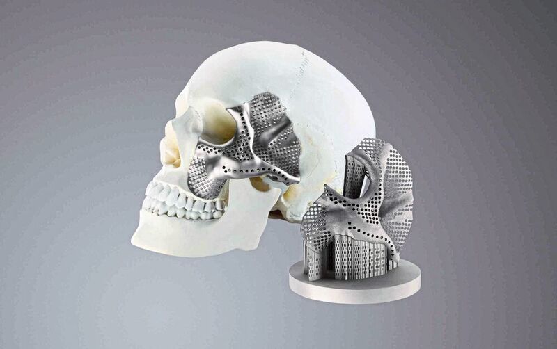 Der Medizintechnik-Hersteller Conmet produziert mit einem 3D-Drucker von Trumpf Schädel- und Kieferimplantate. (Trumpf)
