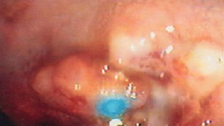 Abb.1: Endoskopischer Nachweis der endogenen PpIX-Fluoreszenz von Tumoren. Zu sehen ist eine optische Faser, die das Anregungslicht durch den Arbeitskanal des Endoskops leitet und gleichzeitig die abgestrahlten Fluoreszenzphotonen zur Analyse über einen Strahlteiler auf den Detektor lenkt. (Bild: MDC Berlin)