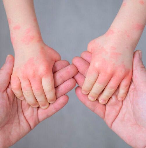 Atopic eczema occurs in 20 – 30 percent of children. 