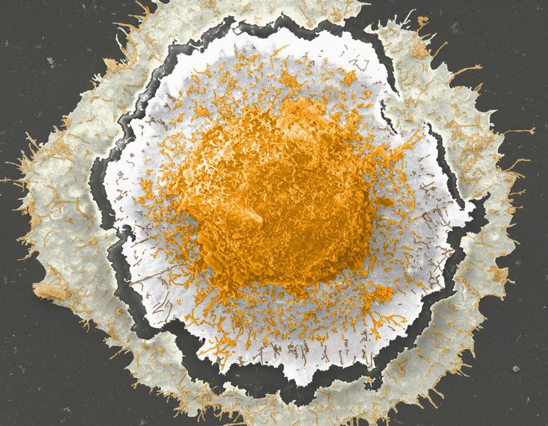 Sunny-side up: Rasterelektronenmikroskopische Aufnahme eines Makrophagen (Bild: Clemens Tscheka, Marius Hittinger, Pascal Schommer, Katrin Voos, Nicole Daum, Marc Schneider/c)
