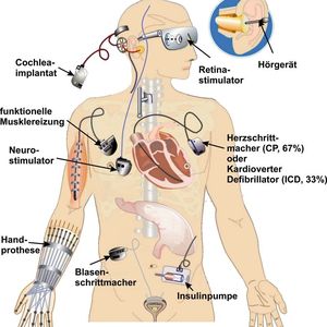 Der ganze Körper ist vernetzt: Beispiele heute schon verfügbarer elektronischer Implantate und Hilfsmittel.