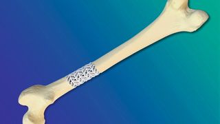 Das Scaffold im Projekt Scabaego lässt sich auf alle großen Röhrenknochen individuell anpassen. Die Anpassung erfolgt auf Basis eines CT des Knochens durch additiven 3D-Druck. (Bild: Fraunhofer IFAM)