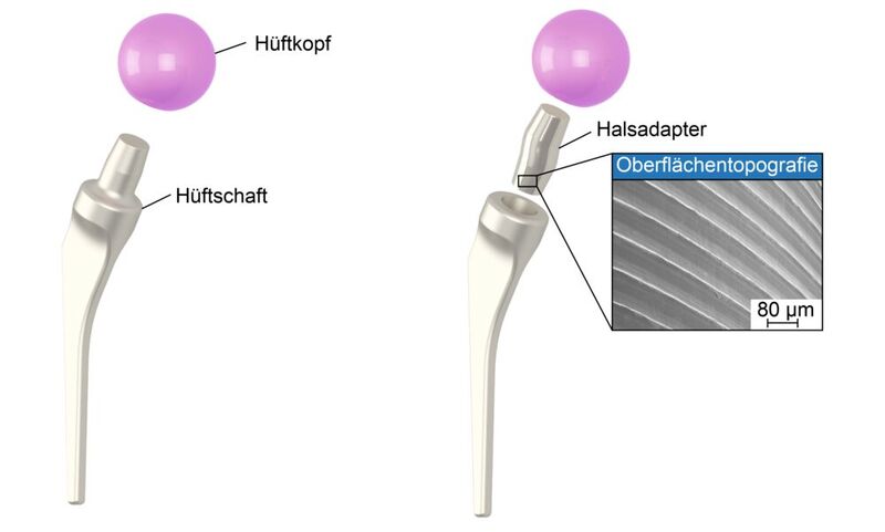 Abb. 1: Doppelt modulare Hüftendoprothese mit Halsadapter.