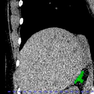 Right adrenal automated 2D segmentation in chest CT.(Source:  Elena Ghotbi, M.D., and RSNA)