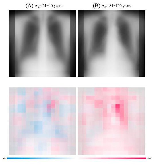 The upper images are the chest radiographs of patients from 21 to 40 years old and from 81 to 100 years old chronologically and the lower images are a visualization of the AI’s focus (both after averaging). Red indicates the points most useful for age determination. The upper images are the chest radiographs of patients from 21 to 40 years old and from 81 to 100 years old chronologically and the lower images are a visualization of the AI’s focus (both after averaging). Red indicates the points most useful for age determination.