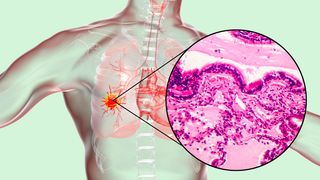 Für die Krebsdiagnose und die Auswahl der richtigen Therapie müssen die Vorgänge in Tumoren auf kleinster Ebene verstanden werden. (Symbolbild) (Bild: © Dr_Microbe - stock.adobe.com)