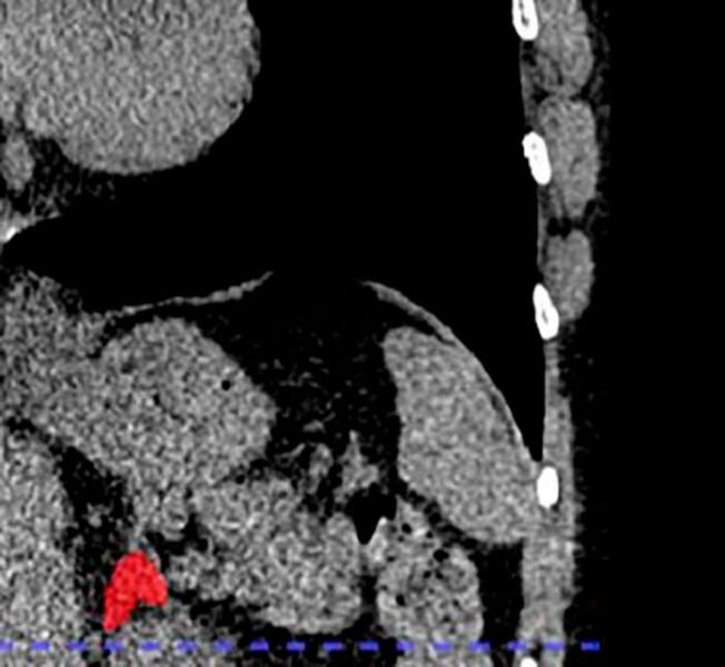 Left adrenal automated 2D segmentation in chest CT. (Source: Elena Ghotbi, M.D., and RSNA)
