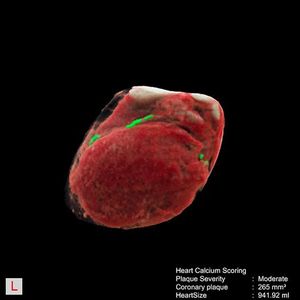 Aus Thorax CT-Aufnahmen erkanntes und segmentiertes Herz mit Herzkranzgefäßen, grün durch KI markiert sind Messungen der Verkalkungen der Herzkranzgefäße.