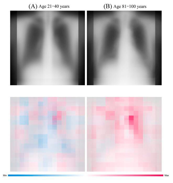 The upper images are the chest radiographs of patients from 21 to 40 years old and from 81 to 100 years old chronologically and the lower images are a visualization of the AI’s focus (both after averaging). Red indicates the points most useful for age determination.