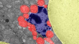 Das Bild zeigt den Querschnitt des mutierten braunen Fettgewebes mit vergrößerten Lipidtröpfchen (gelb) und einem Zellkern (blau), der von mehreren Mitochondrien (rot) umgeben ist. (Bild: Harshita Kaul / Universität zu Köln)