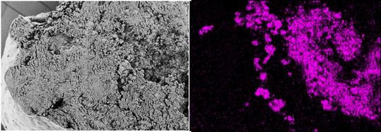 Auch ein Thrombus kann verkalken: Im Rasterelektronenmikroskop (l.) erscheint das Blutgerinnsel homogen. Erst ein Röntgenverfahren, die energiedispersive Röntgenspektroskopie, zeigt im Labor, wie stark verkalkt (violett) der Thrombus ist (r.). (Bild:  Empa)