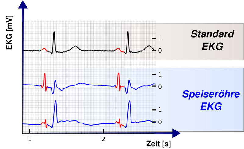 Vergleich eines Standard-EKG (schwarz) mit einem Speiseröhren-EKG (blau). (HuCE, BFH Biel)