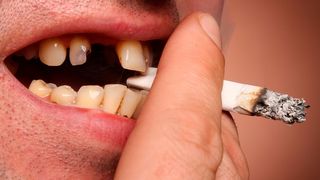 Mehr als 40 Millionen weltweit sind betroffen: Schlechte Zähne durch das Rauchen. (©Igor Gromoff - stock.adobe.com)