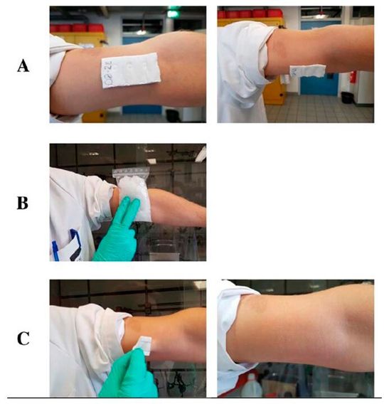 A: Der Verband haftet zuverlässig bei Körpertemperatur, ohne die Bewegungsfreiheit einzuschränken. B: Kontrollierte Ablösung durch Kühlung des Verbandes mit einem Eisbeutel in weniger als einer Minute. C: Nach dem Kühlen kann die Wundauflage schmerzfrei und ohne Kleberückstände entfernt werden. (Bild:  B. Stolz, Institut für Makromolekulare Chemie, Universität Freiburg)