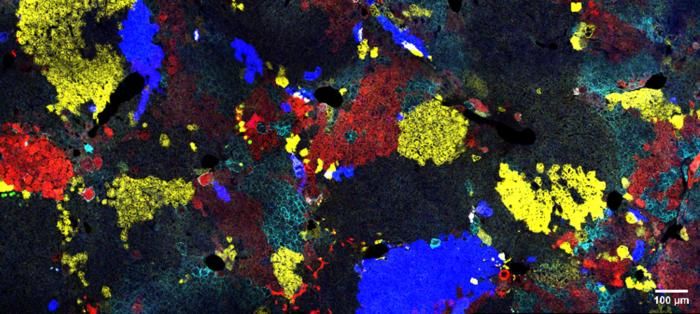 Leberwachstum verstehen  Die Fluoreszenzmikroskopieaufnahme zeigt die Lebersektion einer Maus, bei der verschiedene fluoreszierende Marker verwendet wurden, um spezifische Zellgruppen sichtbar zu machen. Hepatozytengruppen, die denselben Marker teilen, haben einen gemeinsamen klonalen Ursprung, was bedeutet, dass sie von einer gemeinsamen Vorläuferzelle abstammen. Diese Technik ermöglicht es Wissenschaftlern, klonale Beziehungen zu erforschen und die zelluläre Struktur der Leber besser zu verstehen.  In einer neuen Studie des San Raffaele Telethon Instituts für Gentherapie entdeckten Forscher, dass nur 15 bis 20 Prozent der Hepatozyten bei neugeborenen Mäusen – die so genannten klonogenen Hepatozyten – für den Großteil der adulten Lebermasse verantwortlich sind.  Diese Erkenntnis bietet vielversprechende Ansätze für die pädiatrische Gentherapie, da sie helfen könnte, erbliche Lebererkrankungen effektiver zu behandeln Hier gehts zur Originalmeldung Wissenschaftsbild des Tages vom 4.9.2025  (Bild: Alessio Cantore, San Raffaele-Telethon Institute for Gene Therapy)