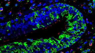 Immunhistologische Färbung von Gewebe eines Nasenpolypen: In Epithelzellen und Entzündungszellen (Zellkerne in blau) sind Komponenten der Leukotrien-Kaskade aktiv (grün: LTC4 Synthase, rot: cysteinyl Leukotrien-Rezeptor 1). (Helmholtz Zentrum München)
