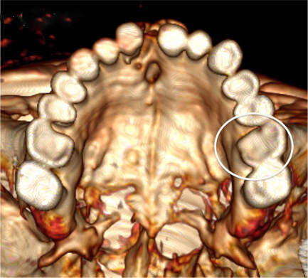 Aufsicht auf den Oberkiefer (3D-Rekonstruktion): Gut sichtbar ist die starke Abschleifung der Zähne. Im Kreis ist am ersten Backenzahn die Fraktur des gaumenseitigen Höckers ersichtlich. Der Backenzahn auf der Gegenseite dagegen ist zwar stark abgeschliffen, seine gaumenseitige Schmelzkante aber noch erhalten. (Bild: UZH)