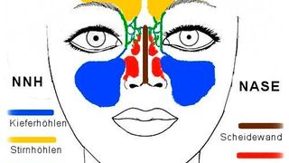 Schätzungsweise 2,5 Mio. Menschen in Deutschland leiden unter nächtlichen Atemaussetzern, dem sogenannten Schlafapnoe-Syndrom, das sich durch lautes Schnarchen bemerkbar macht. (PD Dr. J.-C. Lüers)