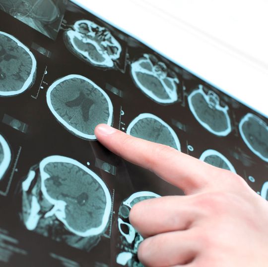 Die Hirnforschung beschäftigt eine besondere Form von Epilepsie, die immunvermittelt ist. Ein FWF-Projekt konnte jetzt zwei dafür verantwortliche Schadensprozesse identifizieren. Die Hirnforschung beschäftigt eine besondere Form von Epilepsie, die immunvermittelt ist. Ein FWF-Projekt konnte jetzt zwei dafür verantwortliche Schadensprozesse identifizieren.