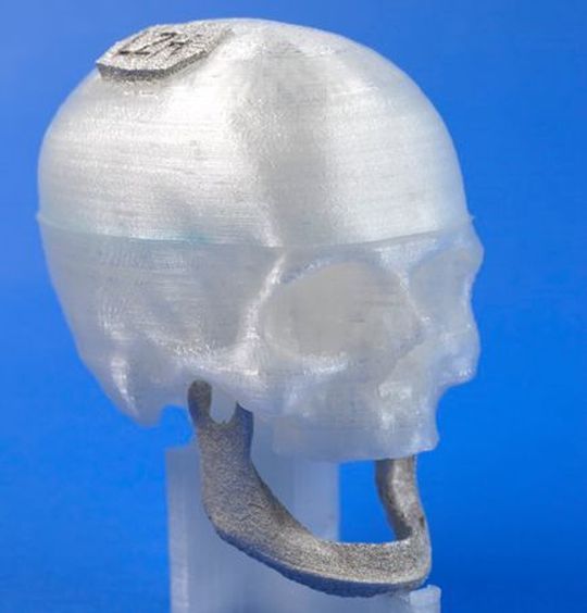 Das Laser Zentrum Hannover hat viel entwicklerisches „Hirnschmalz“ investiert und präsentiert auf der LASYS 2016 in Stuttgart unter anderem wie individuelle Magnesium-Implantate mithilfe des selektiven Laserstrahlschmelzens (SLM) noch besser hergestellt werden können. Das Laser Zentrum Hannover hat viel entwicklerisches „Hirnschmalz“ investiert und präsentiert auf der LASYS 2016 in Stuttgart unter anderem wie individuelle Magnesium-Implantate mithilfe des selektiven Laserstrahlschmelzens (SLM) noch besser hergestellt werden können.