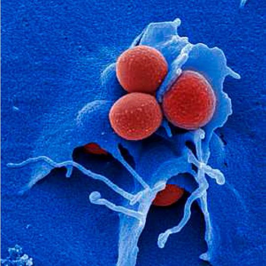 Das Bakterium Staphylococcus aureus (rot) bildet häufig Resistenzen gegen Antibiotika aus. Methicillinresistente Staphylococcus aureus-Stämme (MRSA) sind besonders für Patienten gefährlich, die bereits unter einer Infektion mit dem AIDS-Erreger HIV leiden. Das Bakterium Staphylococcus aureus (rot) bildet häufig Resistenzen gegen Antibiotika aus. Methicillinresistente Staphylococcus aureus-Stämme (MRSA) sind besonders für Patienten gefährlich, die bereits unter einer Infektion mit dem AIDS-Erreger HIV leiden.