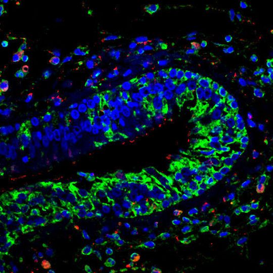 Immunhistologische Färbung von Gewebe eines Nasenpolypen: In Epithelzellen und Entzündungszellen (Zellkerne in blau) sind Komponenten der Leukotrien-Kaskade aktiv (grün: LTC4 Synthase, rot: cysteinyl Leukotrien-Rezeptor 1). Immunhistologische Färbung von Gewebe eines Nasenpolypen: In Epithelzellen und Entzündungszellen (Zellkerne in blau) sind Komponenten der Leukotrien-Kaskade aktiv (grün: LTC4 Synthase, rot: cysteinyl Leukotrien-Rezeptor 1).