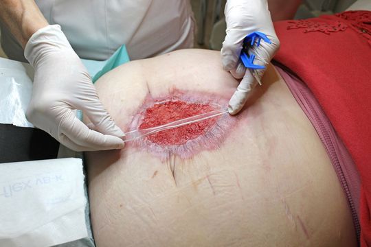 Meding stellt im Kundenauftrag einen neuen, transparenten Wundspatel fürs Débridement her. Für die gewünschte Kontrolle des Wundverlaufs ist eine Messskala eingearbeitet. Meding stellt im Kundenauftrag einen neuen, transparenten Wundspatel fürs Débridement her. Für die gewünschte Kontrolle des Wundverlaufs ist eine Messskala eingearbeitet.