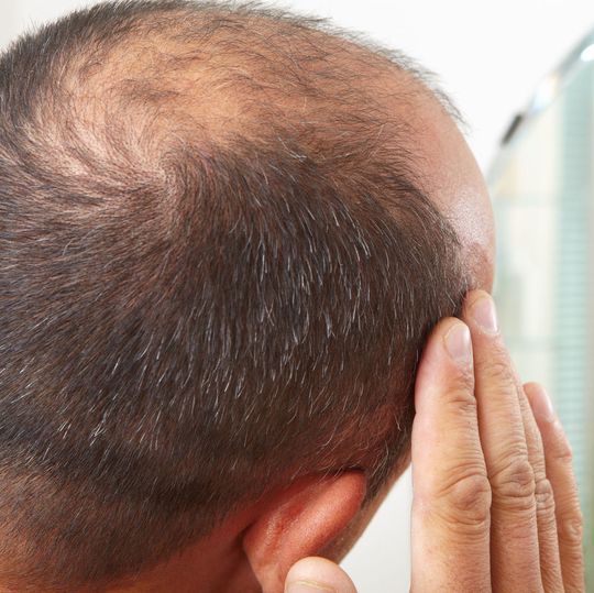 Eine aktuelle genetische Studie deutet darauf hin, dass kleine Männer ein erhöhtes Risiko tragen, durch frühzeitigen Haarausfall eine Glatze zu bekommen. Eine aktuelle genetische Studie deutet darauf hin, dass kleine Männer ein erhöhtes Risiko tragen, durch frühzeitigen Haarausfall eine Glatze zu bekommen.