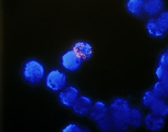 1 Fluoreszenz-in-situ-Hybridisierung (Fish) zur Bestimmung der Genamplifizierung des HER-2-Proteins, eines Indikators für Brustkrebs. 1 Fluoreszenz-in-situ-Hybridisierung (Fish) zur Bestimmung der Genamplifizierung des HER-2-Proteins, eines Indikators für Brustkrebs.