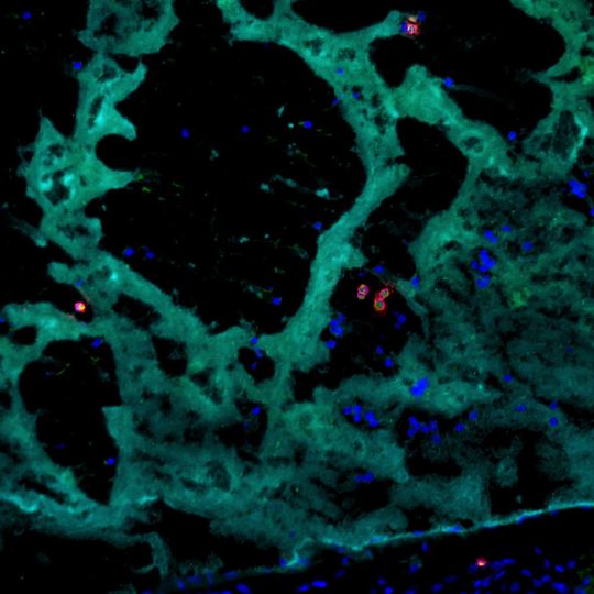 Eosinophile Granulozyten (rote Zellen) tragen innerhalb einer Thrombose (sog. Thrombozyten sind in türkis gefärbt) zum Thrombuswachstum bei. Eosinophile Granulozyten (rote Zellen) tragen innerhalb einer Thrombose (sog. Thrombozyten sind in türkis gefärbt) zum Thrombuswachstum bei.