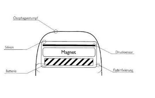 Magnetic Esophageal Advancement. Magnetic Esophageal Advancement.
