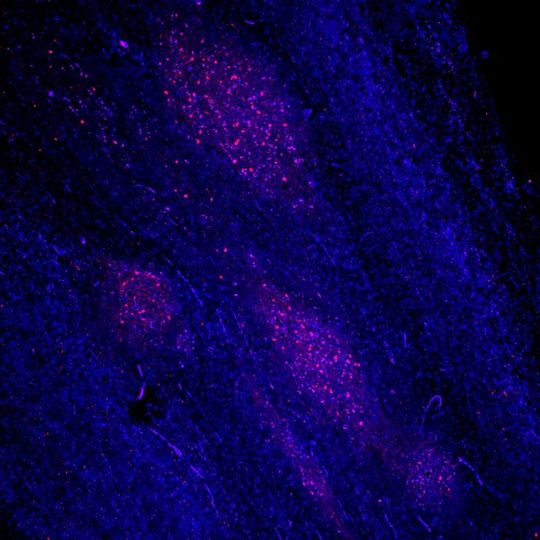 Lewy-Körperchen und Lewy-Neuriten mit fehlerhaft gefaltetem alpha-Synuclein (rot) sind die typischen Krankheitsmerkmale des Gehirngewebes bei der Parkinson-Krankheit (Zellkerne: blau). Lewy-Körperchen und Lewy-Neuriten mit fehlerhaft gefaltetem alpha-Synuclein (rot) sind die typischen Krankheitsmerkmale des Gehirngewebes bei der Parkinson-Krankheit (Zellkerne: blau).