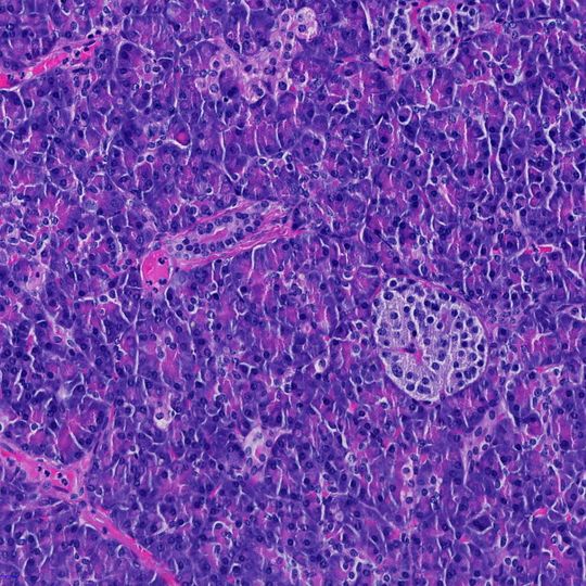 Zellen der Bauchspeicheldrüse, die Insulin produzieren (Mitte). Weisse Blutzellen, die diese schädigen und damit Diabetes auslösen, können auch autoimmune Krankheiten im Darm verursachen. Zellen der Bauchspeicheldrüse, die Insulin produzieren (Mitte). Weisse Blutzellen, die diese schädigen und damit Diabetes auslösen, können auch autoimmune Krankheiten im Darm verursachen.