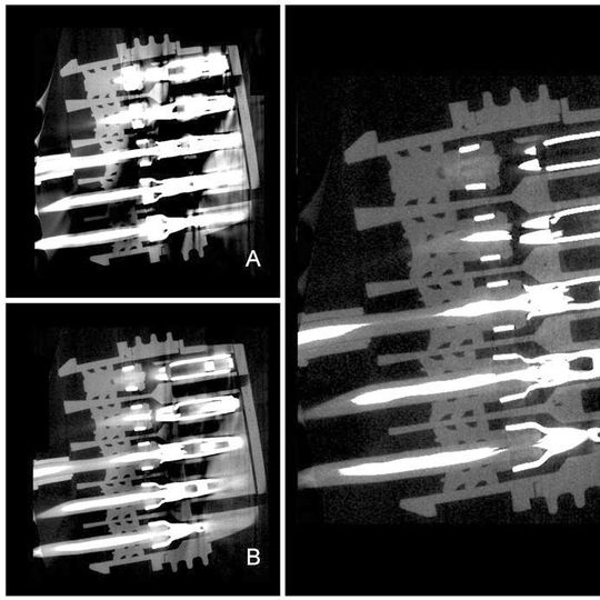 Mehr-Spektren-Tomografie: Durch Kombination mehrerer auf das jeweilige Material abgestimmter CT-Messungen (A und B) werden die Artefakte minimiert (C und D). Mehr-Spektren-Tomografie: Durch Kombination mehrerer auf das jeweilige Material abgestimmter CT-Messungen (A und B) werden die Artefakte minimiert (C und D).