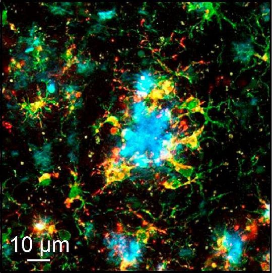 Amyloide Proteinablagerungen (Plaques, blau) in der Großhirnrinde eines Mausmodells der Alzheimer-Erkrankung, umhüllt von kortikalen Immunzellen (Mikroglia, grün). In rot sind diejenigen Mikrogliazellen markiert, die die Fresseigenschaften hoch reguliert haben (positiv für CD-68). Amyloide Proteinablagerungen (Plaques, blau) in der Großhirnrinde eines Mausmodells der Alzheimer-Erkrankung, umhüllt von kortikalen Immunzellen (Mikroglia, grün). In rot sind diejenigen Mikrogliazellen markiert, die die Fresseigenschaften hoch reguliert haben (positiv für CD-68).