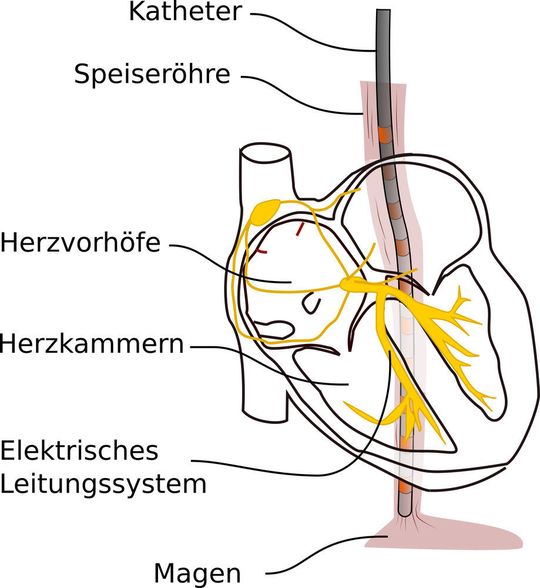 Illustration eines Herzens mit Position des Speiseröhren-EKG-Katheters. Modifizierte Abbildung nach der Dissertation von Simon Mortier an der Medizinischen Fakultät Universität Bern, 2018. Illustration eines Herzens mit Position des Speiseröhren-EKG-Katheters. Modifizierte Abbildung nach der Dissertation von Simon Mortier an der Medizinischen Fakultät Universität Bern, 2018.