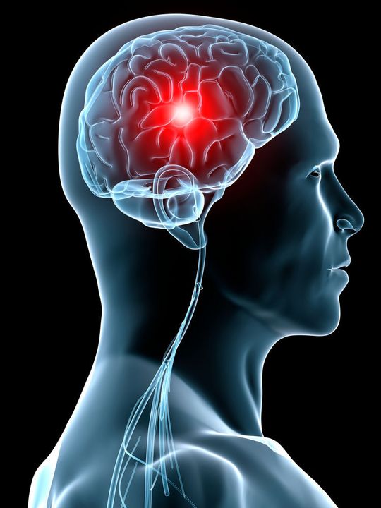 Eine Meta-Studie liefert neue Erkenntnisse über genetische Risikofaktoren für einen Schlaganfall. Eine Meta-Studie liefert neue Erkenntnisse über genetische Risikofaktoren für einen Schlaganfall.