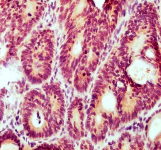 Ein Schnitt durch einen Tumor im Dickdarm einer Maus. Ein wichtiger Cannabinoid-Rezeptor wurde braun eingefärbt.