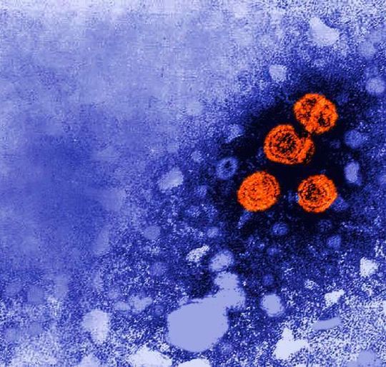 Hepatitis-B-Viruspartikel orange angefärbt; elektronenmikroskopische Aufnahme. Hepatitis-B-Viruspartikel orange angefärbt; elektronenmikroskopische Aufnahme.
