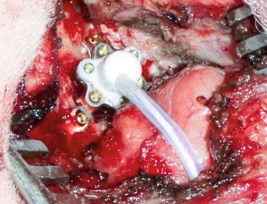 Mit Hörhilfen will der Träger besser hören, sehen soll man sie nach Möglichkteit nicht. Voll implantierbare Hörgeräte, die chirurgisch im Ohr eingesetzt werden, können genau das bieten. Mit Hörhilfen will der Träger besser hören, sehen soll man sie nach Möglichkteit nicht. Voll implantierbare Hörgeräte, die chirurgisch im Ohr eingesetzt werden, können genau das bieten.