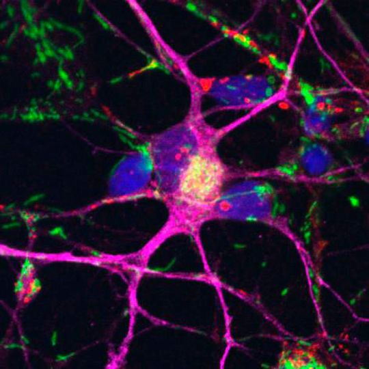 Nervenzellen (lila), die aus Stammzellen von Parkinsonpatienten entwickelt wurden. Die Zellkerne sind blau, die Mitochondrien grün gefärbt. Nervenzellen (lila), die aus Stammzellen von Parkinsonpatienten entwickelt wurden. Die Zellkerne sind blau, die Mitochondrien grün gefärbt.