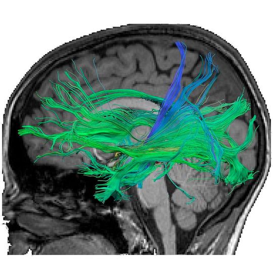 Faserverbindungen im Gehirn, die durch den Hippocampus verlaufen und mit dem Abruf von numerischen Fakten assoziiert sind. Medienbasierte Trainings erhöhten die Stärke und Leitfähigkeit von Fasern, die mit dem Langzeitgedächtnis verbunden sind. Faserverbindungen im Gehirn, die durch den Hippocampus verlaufen und mit dem Abruf von numerischen Fakten assoziiert sind. Medienbasierte Trainings erhöhten die Stärke und Leitfähigkeit von Fasern, die mit dem Langzeitgedächtnis verbunden sind.