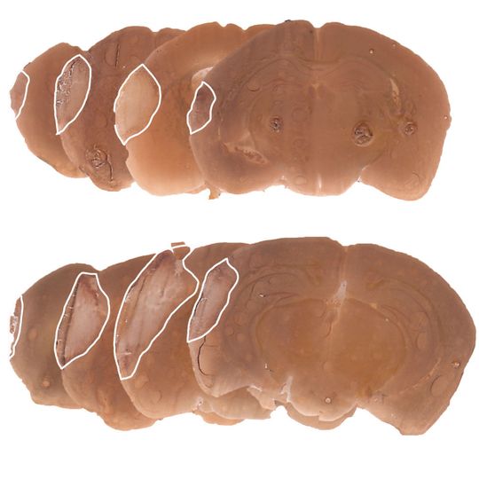 Gehirnschnitte von kontrollbehandelten (unten) und nasal Activin A-behandelten (oben) Mäusen nach einem Schlaganfall. Die weiße Linie markiert die Grenze zwischen den gesunden und geschädigten Gehirnregionen. Gehirnschnitte von kontrollbehandelten (unten) und nasal Activin A-behandelten (oben) Mäusen nach einem Schlaganfall. Die weiße Linie markiert die Grenze zwischen den gesunden und geschädigten Gehirnregionen.