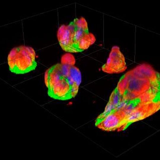 Fluorescence images of pancreatic cancer micro-tumors after overnight culturing. Fluorescence images of pancreatic cancer micro-tumors after overnight culturing.